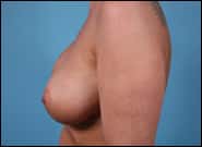 After Image: Breast Augmentation - left-side