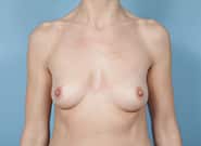 Before Image: Breast Augmentation - front