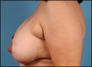 After Image: Breast Augmentation with Mastopexy - left-side
