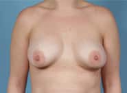 After Image: Breast Augmentation - front