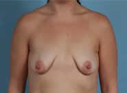 Before Image: Breast Augmentation - front