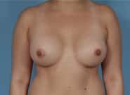 After Image: Breast Augmentation - front