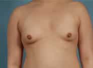 Before Image: Breast Augmentation - front