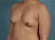 Before Image: Breast Augmentation - left-front-oblique