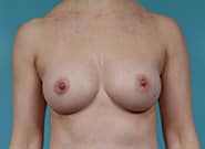 After Image: Breast Augmentation - front