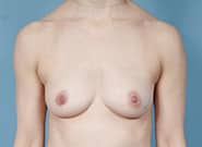 Before Image: Breast Augmentation - front