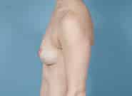 Before Image: Breast Augmentation - left-side