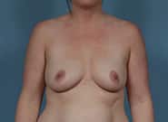 Before Image: Breast Augmentation - front