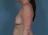 Before Image: Breast Augmentation - left-side