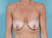 Before Image: Breast Augmentation with Mastopexy - front