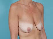 Before Image: Breast Augmentation with Mastopexy - right-front-oblique