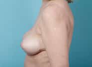After Image: Breast Augmentation with Mastopexy - left-side
