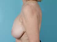 Before Image: Breast Augmentation with Mastopexy - left-side