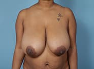 Before Image: Breast Augmentation with Mastopexy - front