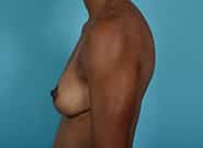 After Image: Breast Augmentation with Mastopexy - left-side