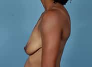 Before Image: Breast Augmentation with Mastopexy - left-side