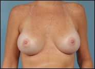 After Image: Breast Augmentation - front