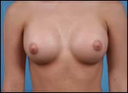 After Image: Breast Augmentation - front