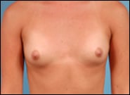 Before Image: Breast Augmentation - front