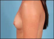 Before Image: Breast Augmentation - left-side