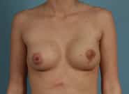 After Image: Breast Reconstruction After Bilateral Nipple Sparing Mastectomy - front