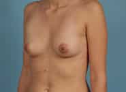 Before Image: Breast Reconstruction After Bilateral Nipple Sparing Mastectomy - left-front-oblique