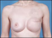 After Image: Breast Reconstruction TE Unilateral, Radiation - front
