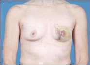 Before Image: Breast Reconstruction TE Unilateral, Radiation - front
