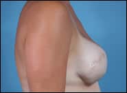 After Image: Breast Reconstruction TE with Lift - right-side