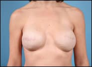 After Image: Breast Reconstruction TE Bilateral - front