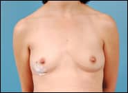 Before Image: Breast Reconstruction TE Bilateral - front