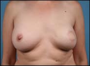 After Image: Breast Reconstruction Latissimus - front