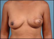 After Image: Breast Reconstruction Latissimus - front