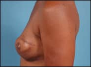 After Image: Breast Reconstruction Latissimus - left-side