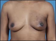 Before Image: Breast Reconstruction Latissimus - front