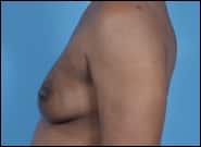 Before Image: Breast Reconstruction Latissimus - left-side