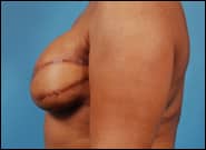 After Image: Breast Reconstruction Latissimus - left-side