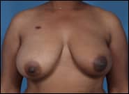 Before Image: Breast Reconstruction Latissimus - front