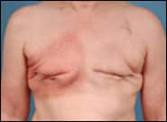 Before Image: Breast Reconstruction with DIEP flaps (Tummy tuck breast reconstruction) - front