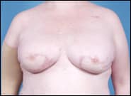 After Image: Breast Reconstruction with DIEP flaps (Tummy tuck breast reconstruction) - front