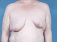 Before Image: Breast Reconstruction with DIEP flaps (Tummy tuck breast reconstruction) - front