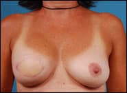 After Image: Breast Reconstruction with right free DIEP flap (Tummy tuck breast reconstruction) - front