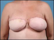 After Image: Breast Reconstruction with free DIEP flaps (Tummy tuck breast reconstruction) - front