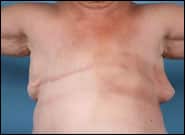 Before Image: Breast Reconstruction with free DIEP flaps (Tummy tuck breast reconstruction) - front