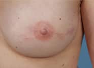 After Image: Breast Reconstruction After Bilateral Nipple Sparing Mastectomies - front