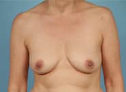 Before Image: Breast Reconstruction After Bilateral Nipple Sparing Mastectomies - front