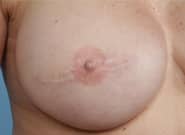 Before Image: Breast Reconstruction After Bilateral Nipple Sparing Mastectomies - front