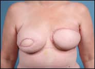 After Image: Breast Reconstruction with bilateral DIEP flaps (Tummy tuck breast reconstruction) - front