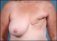 Before Image: Breast Reconstruction with bilateral DIEP flaps (Tummy tuck breast reconstruction) - front