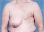 Before Image: Breast Reconstruction with left tummy tuck breast reconstruction and right breast lift - front